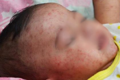 Ilustrasi penyakit campak. Foto: Net